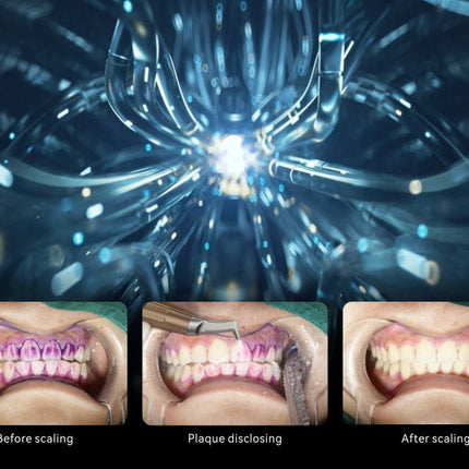 WOODPECKER AP - B Dental Scaler und Air Polisher - SurgicMateWOODPECKER
